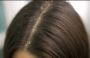 Dandruff