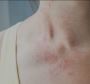 Atopic dermatitis Atopic dermatitis