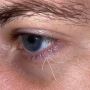 Blepharitis Vs Demodex