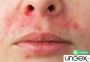 perioral dermatitis