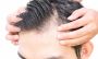 Natural Scalp | New York Scalp Micropigmentation Clinic