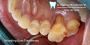 Nassau County’s Trusted Gum Recession Specialist