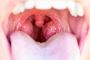 Tonsillitis - Neeti Clinics Tonsillitis - Neeti Clinics