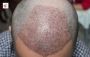 Top Hair Transplant Clinic: NeoGraft Hair Clinic, Chandigarh