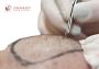 Hair Transplant In Chandigarh - NeoGraft Hair Clinic