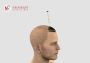 Where to Find the Best Hair Transplant in Chandigarh?