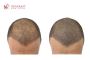 Trusted Hair Transplant in Chandigarh
