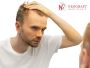 Where is the best hair transplant in India, Chandigarh?