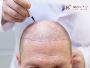 Expert Hair Transplant in Chandigarh, india 2024 