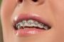 Straighten Your Teeth Discreetly with Clear Braces