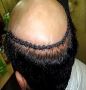 Transform Your Look with Expert Hair Replacement in Mumbai 