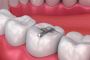 We Provide Best Dental Filling Service In Newmarket 