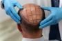 Hair Transplant in Ahmedabad