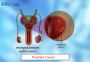 Top-Quality Prostate Cancer Treatment in India at Affordable
