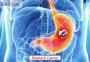 Affordable Stomach Cancer Treatment in India with Expert Car