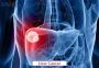 Advanced Liver Cancer Treatment in India with Affordable Cos