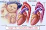 Affordable & Advanced Treatment for Coarctation of the Aorta
