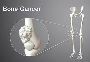 Affordable & Advanced Bone Cancer Treatment in India – Consu