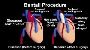 Affordable Bentall Procedure in India – Book Your Heart Surg