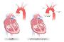 Affordable Coarctation Of The Aorta Treatment in India 