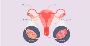 Laparoscopic Ovarian Drilling in India