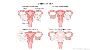 Safe and Advanced Salpingo-Oophorectomy Treatment