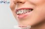 Affordable Fixed Braces Treatment in India – Straighten Your
