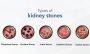 Behind the pain: The warning signs of Kidney Stones Symptoms