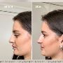 Book Non-Surgical Rhinoplasty – Instant Results