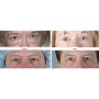 Blepharoplasty Surgery
