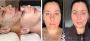 Achieve Clearer Skin with Our Acne Clear Skin Repair Program