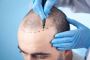 Hair Restoration Services in Richmond, VA – Transform Your L