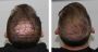 Hair Restoration Richmond VA by Nova Faces – Regain Thicker,