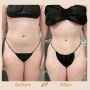 Hip Contouring Surgery