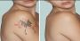 Get the best Laser Tattoo Removal in Annerley Get the best Laser Tattoo Removal in Annerley