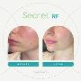 Looking for an Effective Skin Rejuvenation Treatment with Se