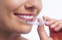 Teeth braces | Only braces