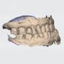 Get Expert Dentistry for Complex Restorations Prosthodontics