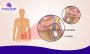Advanced and Reliable Varicocele Treatment in Bangalore 