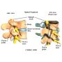 Facet Injections for Back Pain