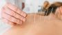 Acupuncture Hamilton