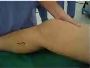 5 Benefits of Choosing Singapore for ACL Surgery