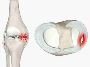 Ankle Ligament Tear: Is It a Break?