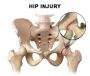 Hip Pain Treatment