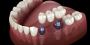 Restore Your Smile with Dental Implants at Paragon Dental 