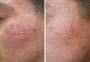 Looking for Effective RF Skin Rejuvenation in the UK?