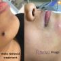 Mole removal clinic in london