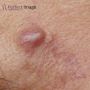 cyst removal near me
