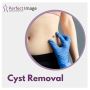 Cyst removal cost