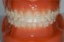 Best Invisible Braces in Bangalore | Dental Braces